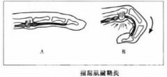 徐州市康復(fù)醫(yī)院醫(yī)生提醒：小小腱鞘炎，需要大注意
