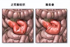 什么是急性腸套疊？徐州兒科專家詳解兒外科常見的急腹癥