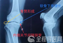 骨關(guān)節(jié)炎的發(fā)病因素有哪些？徐州康復(fù)醫(yī)院為你科普